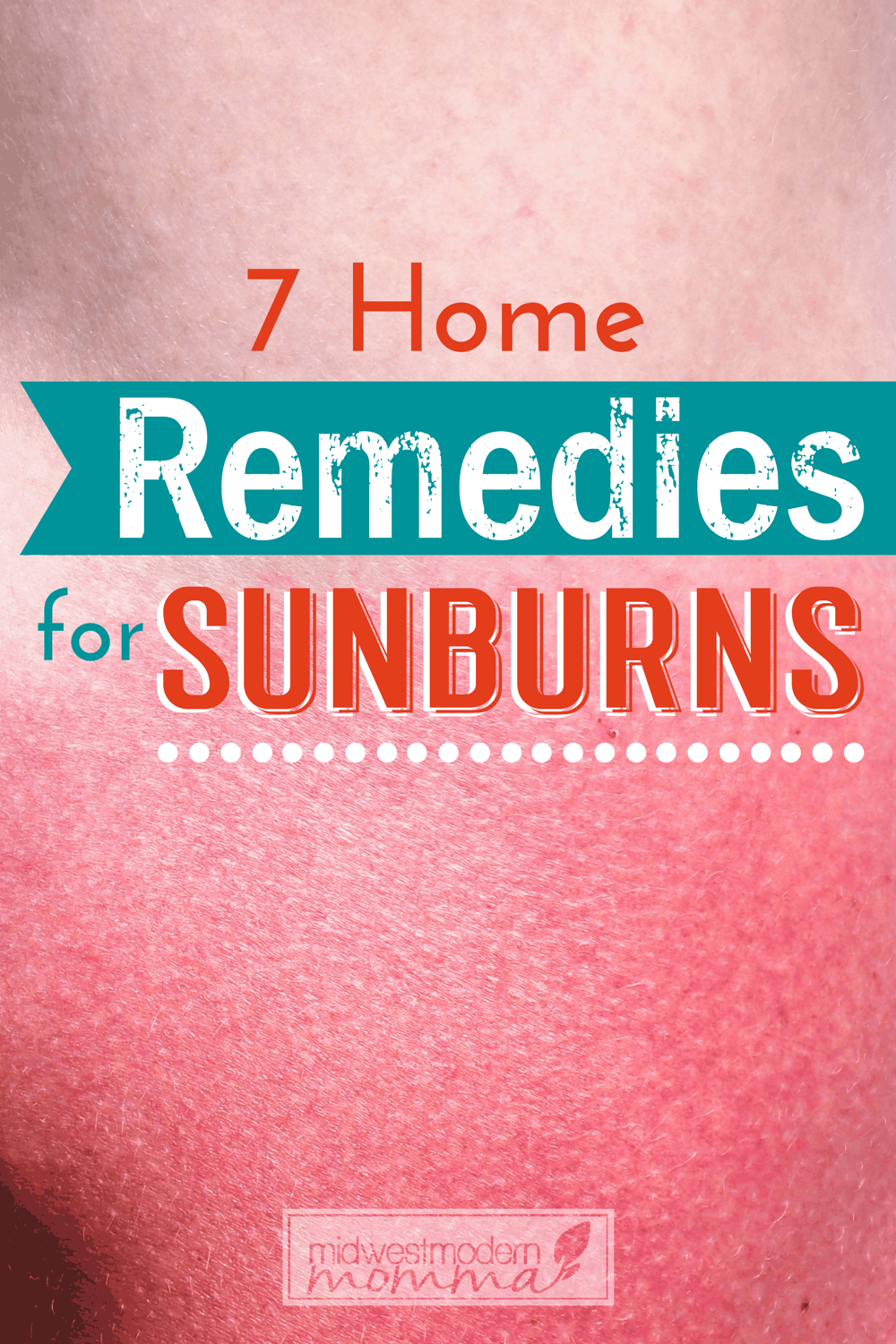 7 Home Remedies For Sunburn